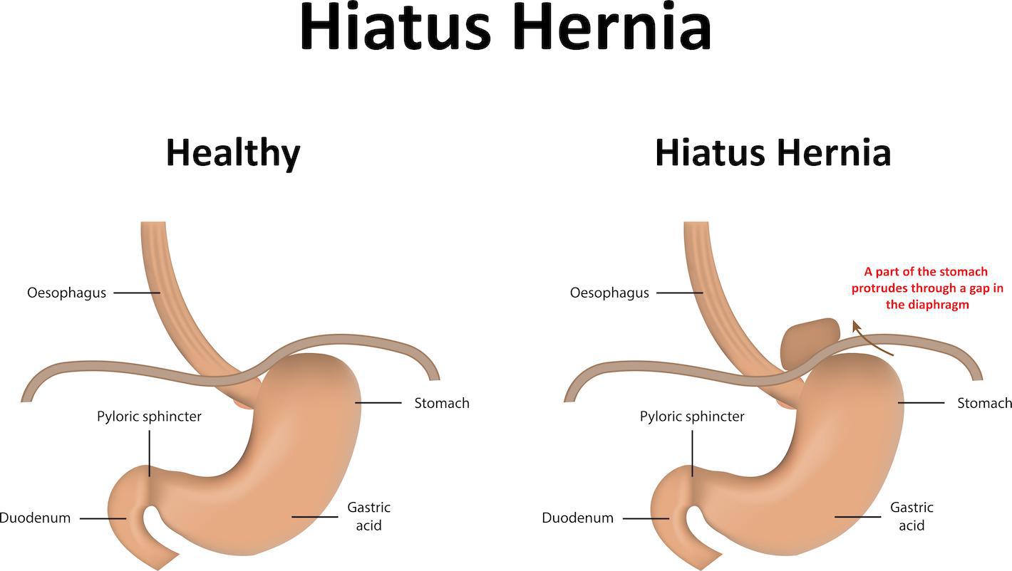 hiatal hernia symptoms and treatment : The Burning Truth You Need to Know